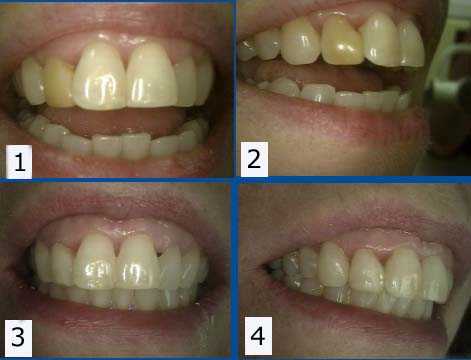 dental bonding color shade cosmetic dentistry dark tooth lateral incisor teeth