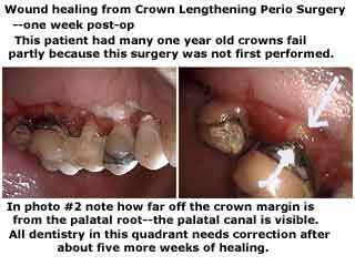 gum surgery Periodontal gingival surgery, crown lengthening, wound healing, postop, post-op