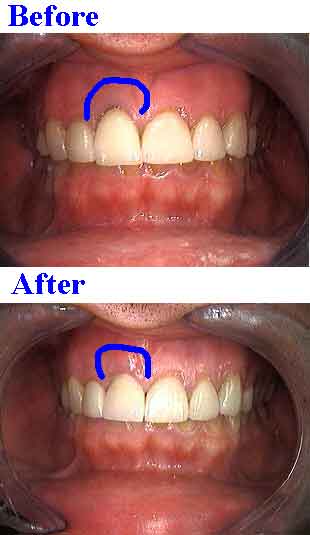 gingival margins gingivitis dark color darkness black gums around a porcelain crown cap