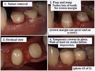 how to dental crown teeth caps technique preparation after gum gingival surgery, impression taking