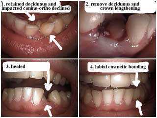 labial tooth surface bonding, deciduous tooth, crown lengthening gum surgery, periodontist