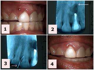 porcelain laminates veneers problems complications acute periodontal abscess Procera Lava Cerinate
