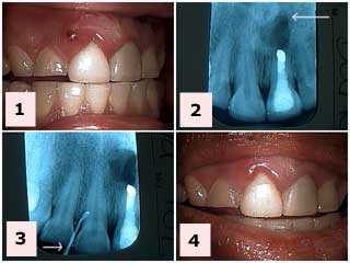 plaque, calculus, acute periodontal abscess, gum, gingivitis, periodontitis, pain, fistula, boil