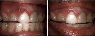 tooth veneers problems, complications acute periodontal abscess, gum pain fistula Lumineers