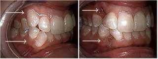arch length measurement, ectopic canine crowded pushed out labial extraction tooth ectopic teeth