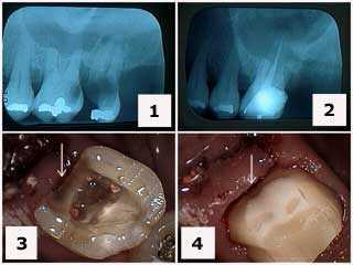 Crown Buildup, composite dental resin core, dental bonding, how to, x-rays, teeth radiographs