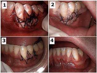 mucogingival junction involvement graft recession gum receded gums surgery, recipient site post op 
