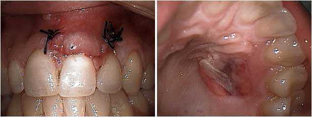 periodontal recession surgery free gingival graft, gum loss, receded biologic width attachment loss