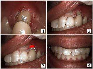 fix Tooth Bridge Repair with Bonding, Gingival Margin, Gingivectomy, Broken cap crown