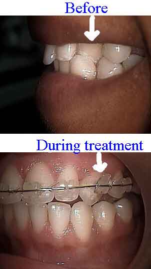 x-bite, crossbite, tooth cross bite, teeth, dental, braces, orthodontics, dentistry, bad bite