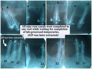 post-operative radiographs x-ray xray, endodontics, root canal, xrays, x-rays, provisionals dental 