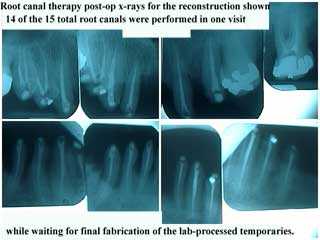 post-operative radiographs, x-rays, endodontics, root canal, xrays, smile makeover xray