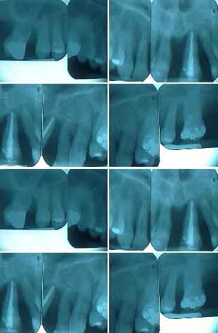 xray dental reconstruction x-ray oral rehabilitation x-rays xrays smile makeover radiograph teeth