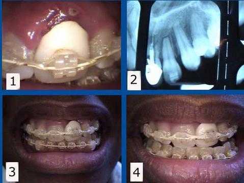 complications porcelain crowns caps failure braces orthodontic problems treatment plan implants