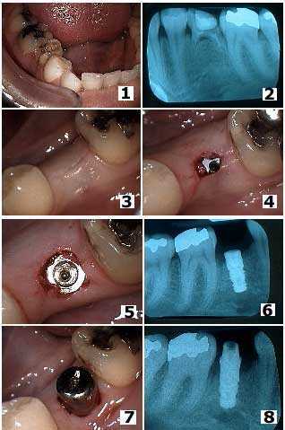 Primary Dentition baby tooth Single Tooth dental Implant, Healing Collar, Extraction xray