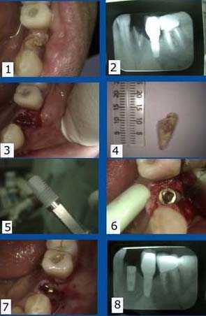 single tooth dental implant, extraction, oral surgery, fracture broken tooth chip infection