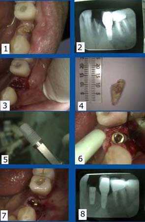 dental implant xray