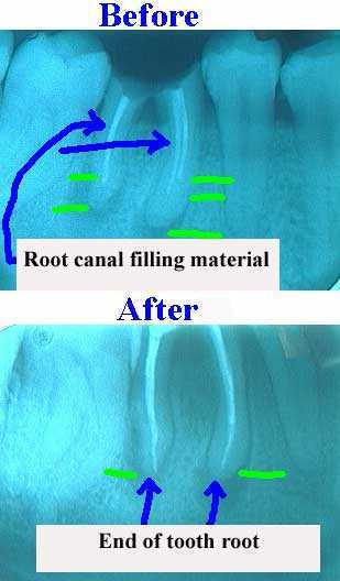 endodontics root canal, re-treatment, failure incomplete inadequate xray fill obturation retreatment