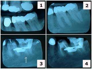 x-ray tooth calcification xray dental endodontics root canal instrumentation radiograph cleaning