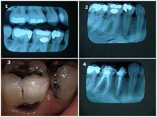 x-ray tooth pain emergency decay tooth cavity dental caries root canal periapical radiolucency
