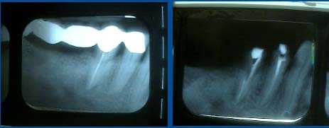 complications, fixed porcelain metal cap dental bridge, failure, abutments decayed cavity, cement