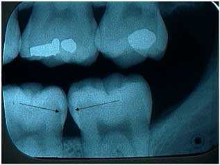 x-ray xray tooth decay cavity dental caries x-rays xrays teeth cavities bitewings interproximal 