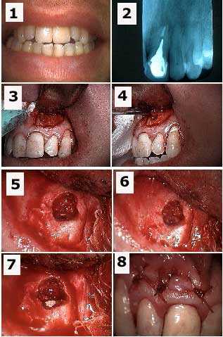 apicoectomy, root canal apical gum oral surgery, semi-lunar incision, cystic tissue, fenestration
