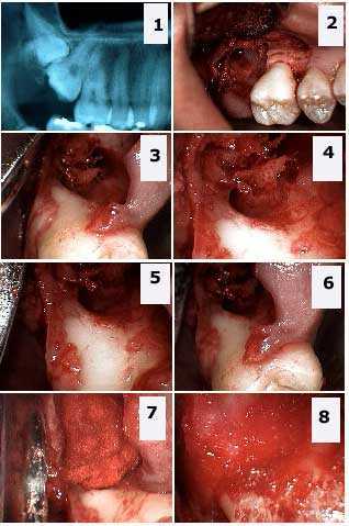 Bone, jaw, jawbone, maxilla, mandible, alveolar ridge, dental alveolus, Osseous Defect Surgery photo