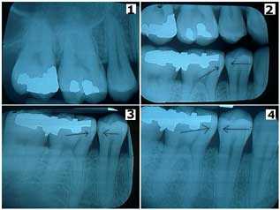 x-rays digital xrays teeth cavities periapical bitewings interproximal radiographs x-ray xray tooth 