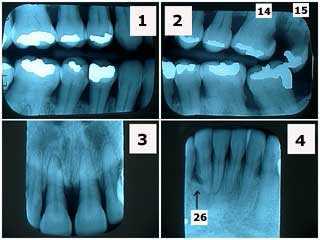 x-ray, radiographs, severe periodontal gum disease, horizontal bone loss, maxilla, mandible