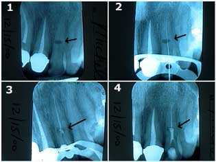 Trauma, teeth injury, dental accidents fighting falling internal resorption root canal endodontics