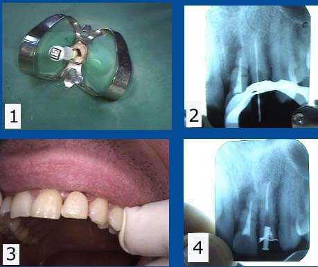 root canal endodontic retreatment, incomplete inadequate instrumentation fill obturation chloroform