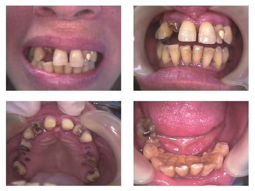 one day dental reconstruction of a phobic patient