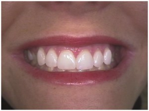 porcelain tooth veneer preparation