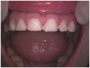dental veneers laminates procedure