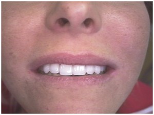 cosmetic dentistry porcelain tooth teeth dental veneers laminates