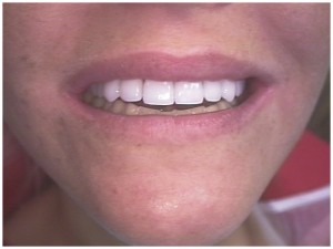 cosmetic dentistry porcelain tooth teeth dental veneers laminates procedure technique