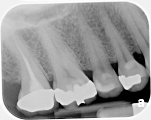 dental x-ray xray radiograph of a tooth that needs root canal therapy