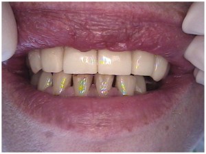 cosmetic dentist porcelain bridge caps crowns