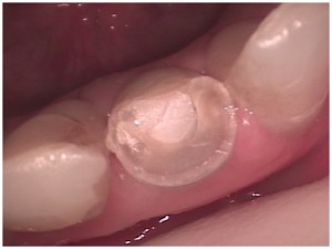dentistry to repair a broken lower front tooth