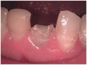 cosmetic dentistry repair of fractured lower teeth