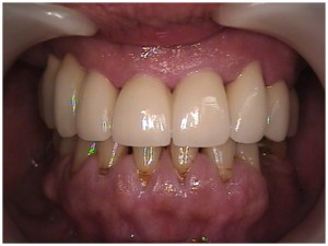 tooth caps teeth crowns dental bridge porcelain reconstruction roundhouse