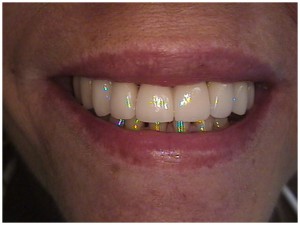 smile makeover extreme smile make over dental dentistry
