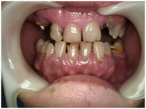 dental fear of dentist phobia anxiety dentistry