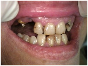 dental tooth teeth smile reconstruction, dental phobia, fear of dentist