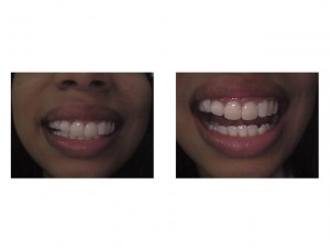 teeth bonding with composite