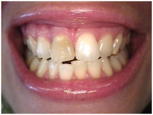 tooth bleaching, dental whitening a dark front tooth