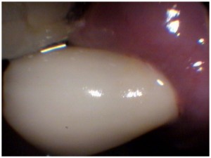 dental x-rays of root canal therapy for a broken tooth