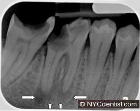 Root canal infection seen as periapical pathology or periapical radiolucency in a dental x-ray.