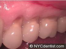 Tooth erosion or abrasion